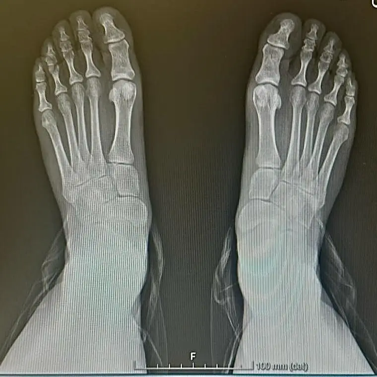 Rehabilitación postoperatoria